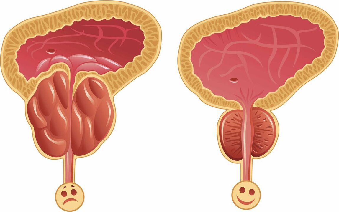 Prostata przed i po leczeniu kapsułkami Prostaffect