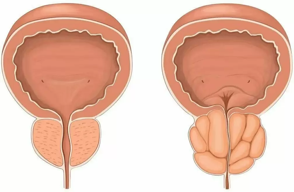 normalna prostata i chora prostata